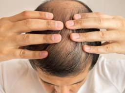 Los mejores tratamientos de pérdida de cabello para hombres