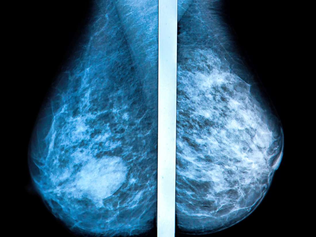 Tomosyntéza: metoda screeningu rakoviny prsu