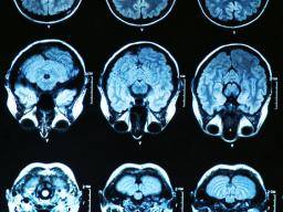 Schädel-Hirn-Trauma bei älteren Erwachsenen im Zusammenhang mit einem erhöhten Demenzrisiko