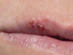 Opciones de tratamiento para el herpes labial en las primeras etapas