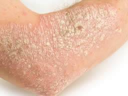 La prueba de dos genes diferencia la psoriasis del eczema