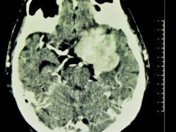 Typy, príznaky a lécba nádoru na mozku