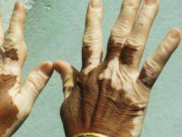 Verständnis der Symptome von Vitiligo
