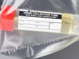 Test d'urine pour le diabète: ce que vous devez savoir
