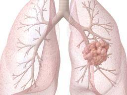 Was sind die Stadien von Lungenkrebs?