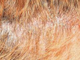 Que puis-je faire au sujet du psoriasis du cuir chevelu?