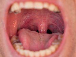Was verursacht eine geschwollene Uvula?