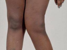 Quelles sont les causes du genu valgum (knock-knees)?