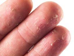 ¿Qué causa que la piel en las yemas de los dedos se pele?
