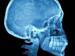 Wat is craniosynostosis?