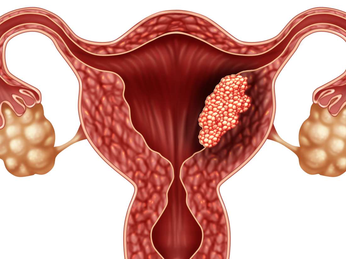 Co je rakovina endometria?