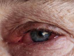 Co je infekcní konjunktivitida nebo ruzové oko?