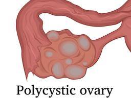 Was ist das polyzystische Ovarialsyndrom?
