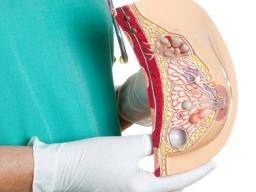 Co je rozptýlené fibroglandulární prsní tkán?