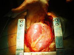 Was sollte ich bei Operationen am offenen Herzen erwarten?