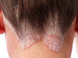 Was man über Kopfhautpsoriasis wissen sollte
