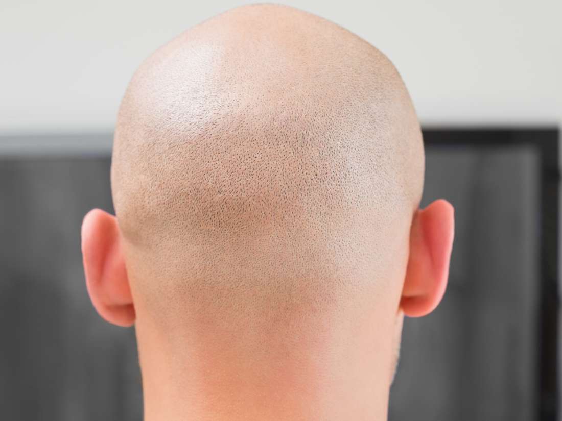 Lo que debes saber sobre la alopecia total