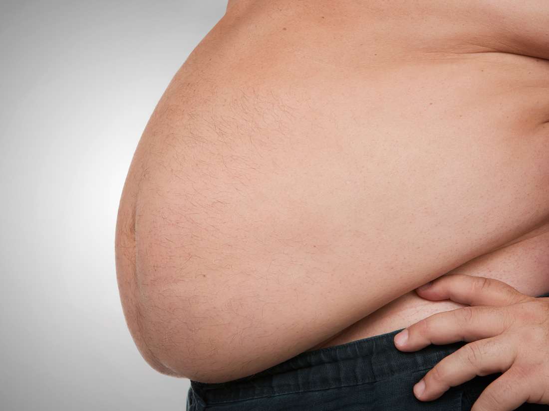 Lo que debes saber sobre la obesidad mórbida