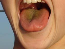 Lo que debes saber sobre la lengua amarilla