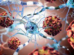 Was ist die Verbindung zwischen Multipler Sklerose und dem JC-Virus?