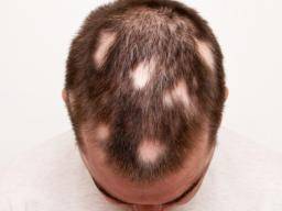Was ist über Alopecia areata zu wissen?