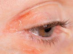 Was ist über Psoriasis auf den Augenlidern zu wissen?