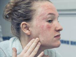 Was ist über Psoriasis im Gesicht zu wissen?