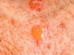 Que faut-il savoir sur le cancer de la peau et les éruptions cutanées?