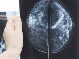 Que savoir sur le cancer du sein triple négatif?