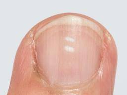 Bílé skvrny na nehty: Príciny, prevence a lécba