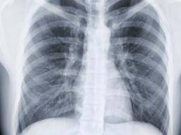 WHO-Bericht: TB ist weiter verbreitet als bisher angenommen