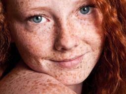 ¿Por qué las pelirrojas contraen melanoma con más frecuencia?