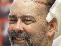 Weltweit erste Schädel-Kopfhaut-Transplantation in Texas Man